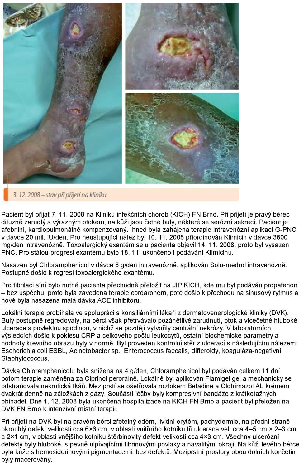 2008 přiordinován Klimicin v dávce 3600 mg/den intravenózně. Toxoalergický exantém se u pacienta objevil 14. 11. 2008, proto byl vysazen PNC. Pro stálou progresi exantému bylo 18. 11. ukončeno i podávání Klimicinu.