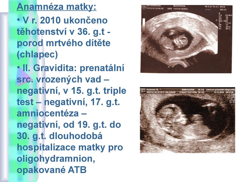 vrozených vad negativní, v 15. g.t. triple test negativní, 17. g.t. amniocentéza negativní, od 19.