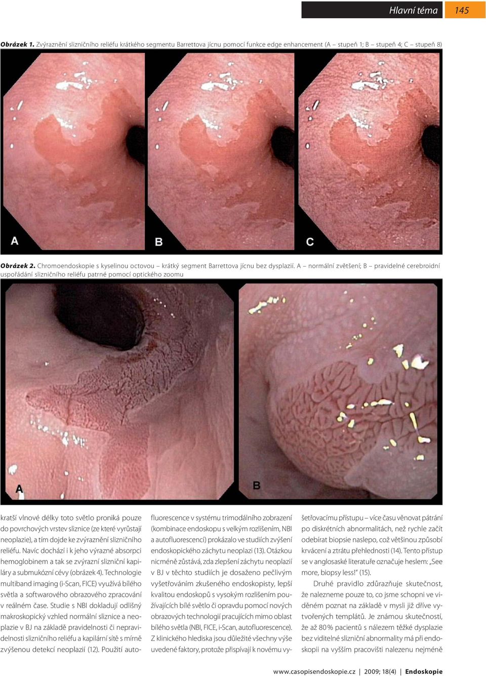 A normální zvětšení; B pravidelné cerebroidní uspořádání slizničního reliéfu patrné pomocí optického zoomu kratší vlnové délky toto světlo proniká pouze do povrchových vrstev sliznice (ze které