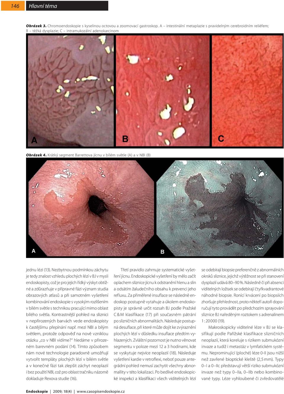 Krátký segment Barrettova jícnu v bílém světle (A) a v NBI (B) jednu lézi (13).