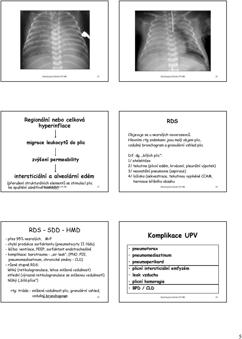 dg. bílých plic : 1/ atelektáza 2/ tekutina (plicní edém, krvácení, pleurální výpotek) 3/ neonatální pneumonie (aspirace) 4/ ložisko (sekvestrace, tekutinou vyplněné CCAM, herniace břišního obsahu