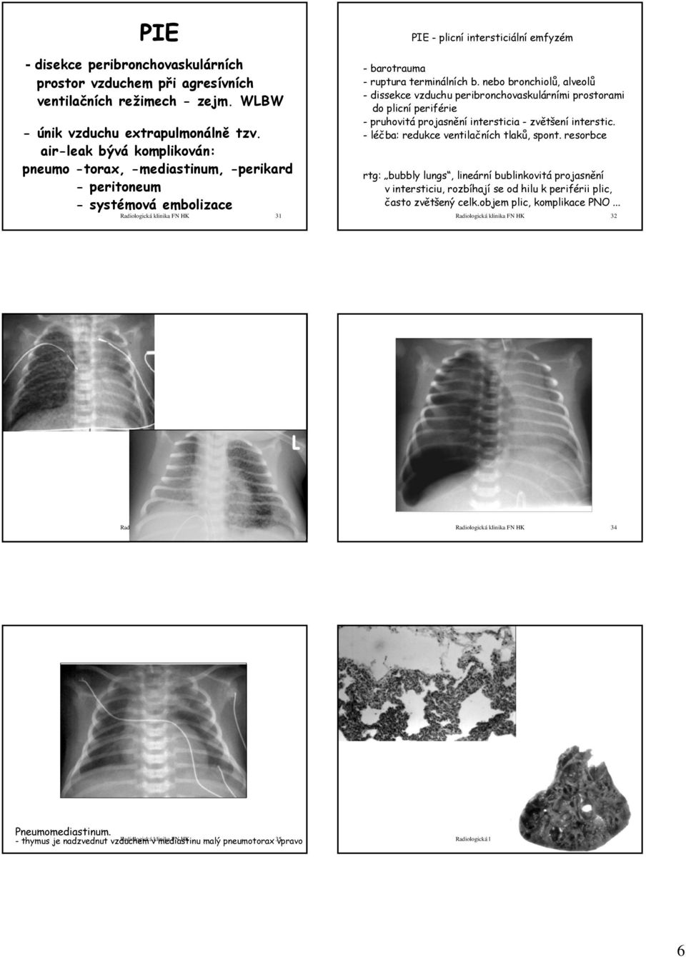 terminálních b. nebo bronchiolů, alveolů - dissekce vzduchu peribronchovaskulárními prostorami do plicní periférie -pruhovitáprojasnění intersticia - zvětšení interstic.