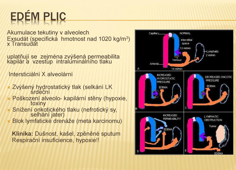 (selkání LK srdeční Poškození alveolo- kapilární stěny (hypoxie, toxiny Snížení onkotického tlaku (nefrotický sy,