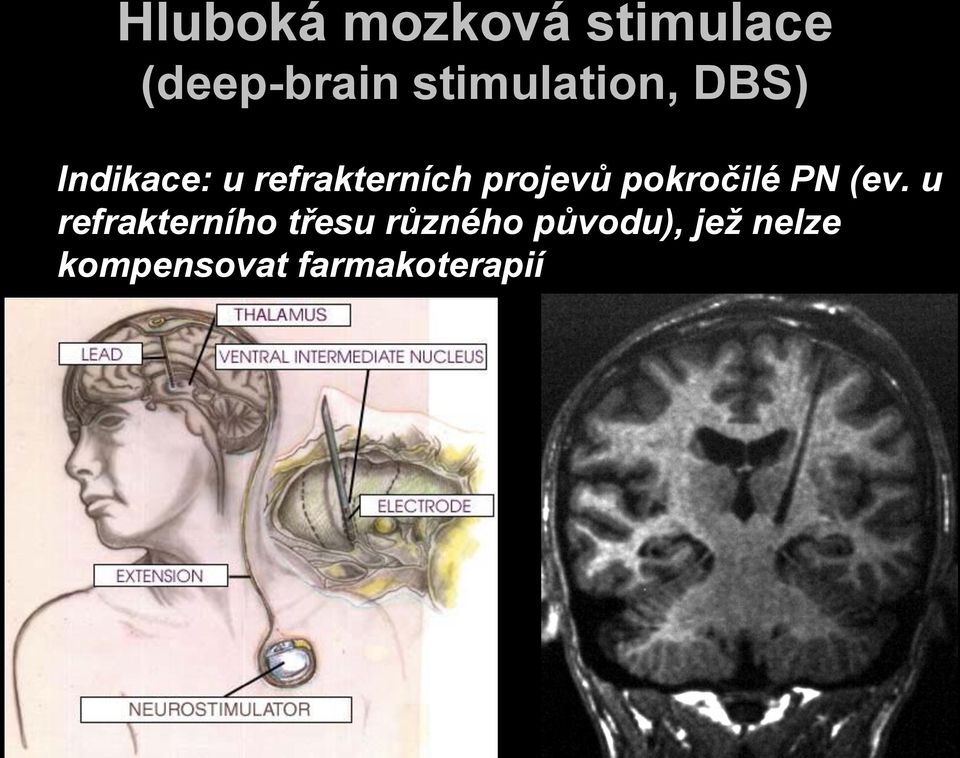 projevů pokročilé PN (ev.