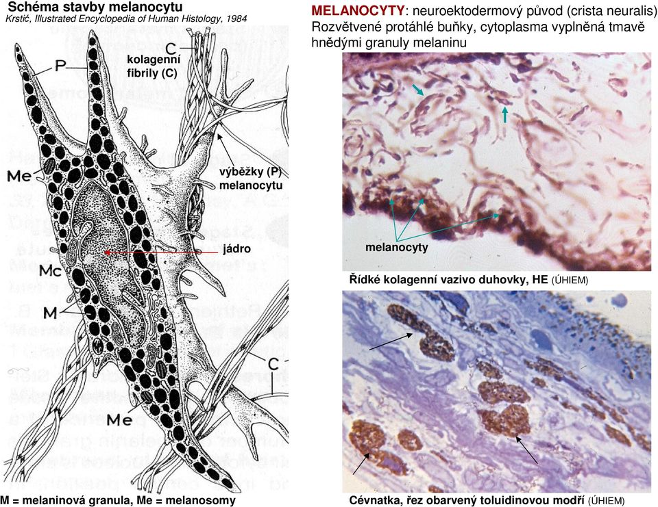 vyplněná tmavě hnědými granuly melaninu výběžky (P) melanocytu jádro melanocyty Řídké kolagenní