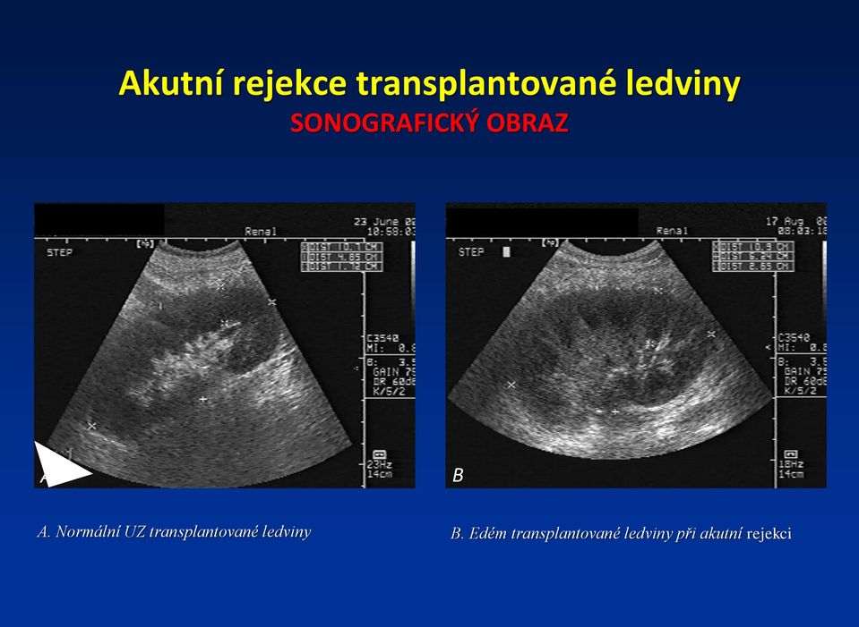 Normální UZ transplantované ledviny B.