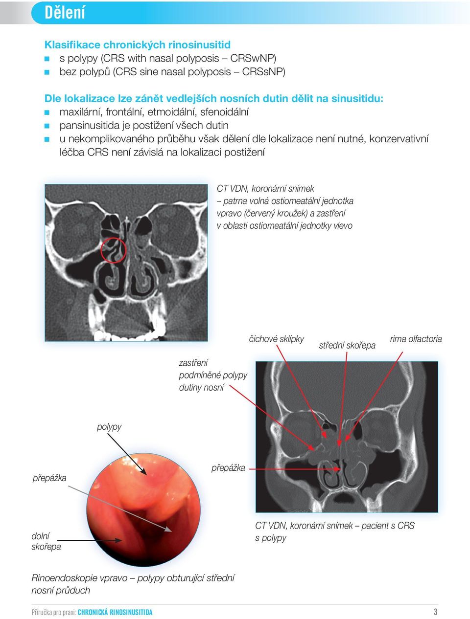na lokalizaci postižení CT VDN, koronární snímek patrna volná ostiomeatální jednotka vpravo (červený kroužek) a zastření v oblasti ostiomeatální jednotky vlevo zastření podmíněné polypy dutiny nosní