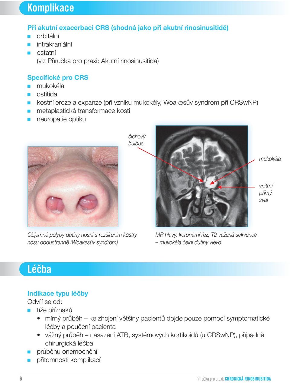rozšířením kostry nosu oboustranně (Woakesův syndrom) MR hlavy, koronární řez, T2 vážená sekvence mukokéla čelní dutiny vlevo Léčba Indikace typu léčby Odvíjí se od: tíže příznaků mírný průběh ke