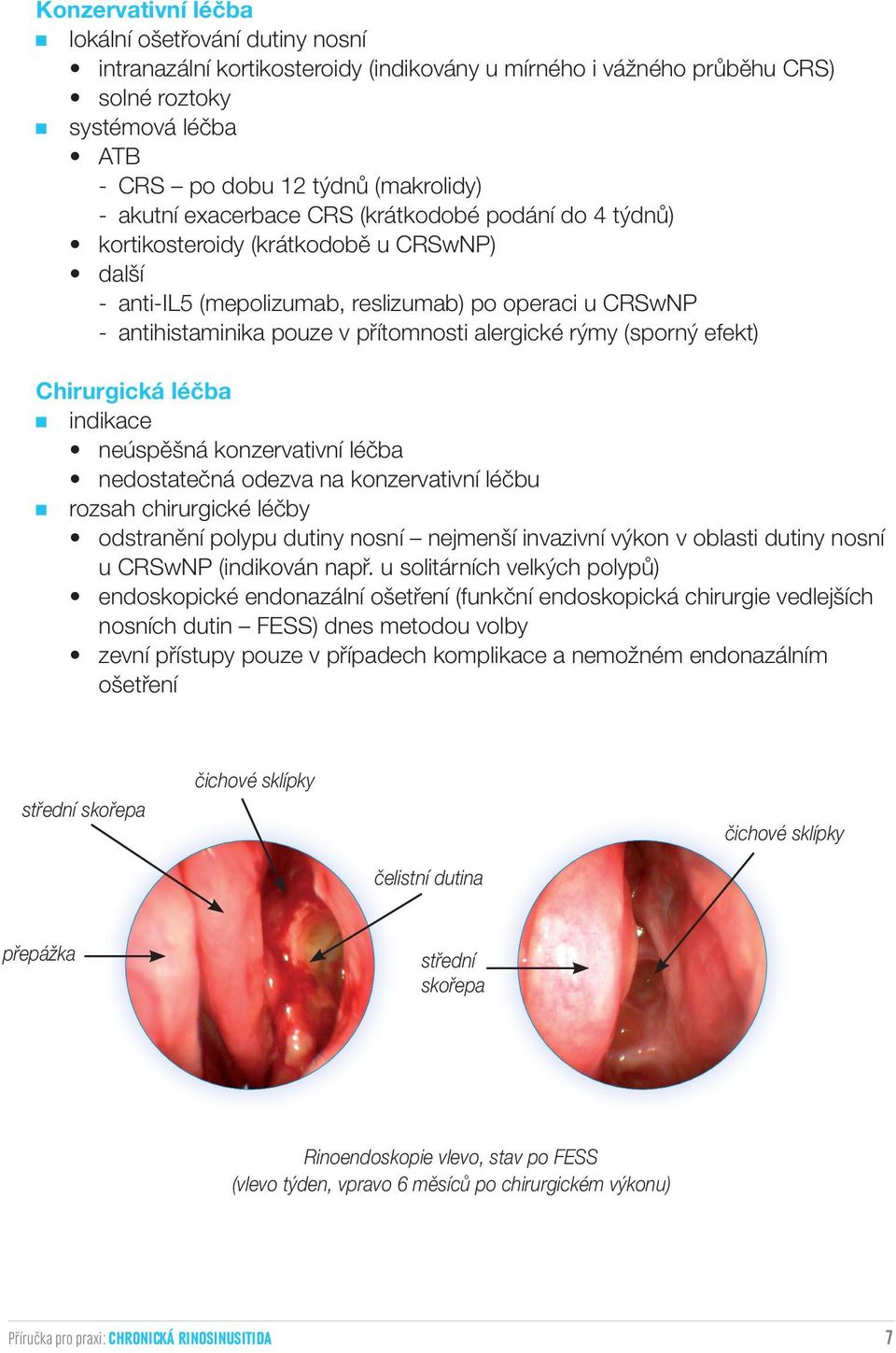 alergické rýmy (sporný efekt) Chirurgická léčba indikace neúspěšná konzervativní léčba nedostatečná odezva na konzervativní léčbu rozsah chirurgické léčby odstranění polypu dutiny nosní nejmenší