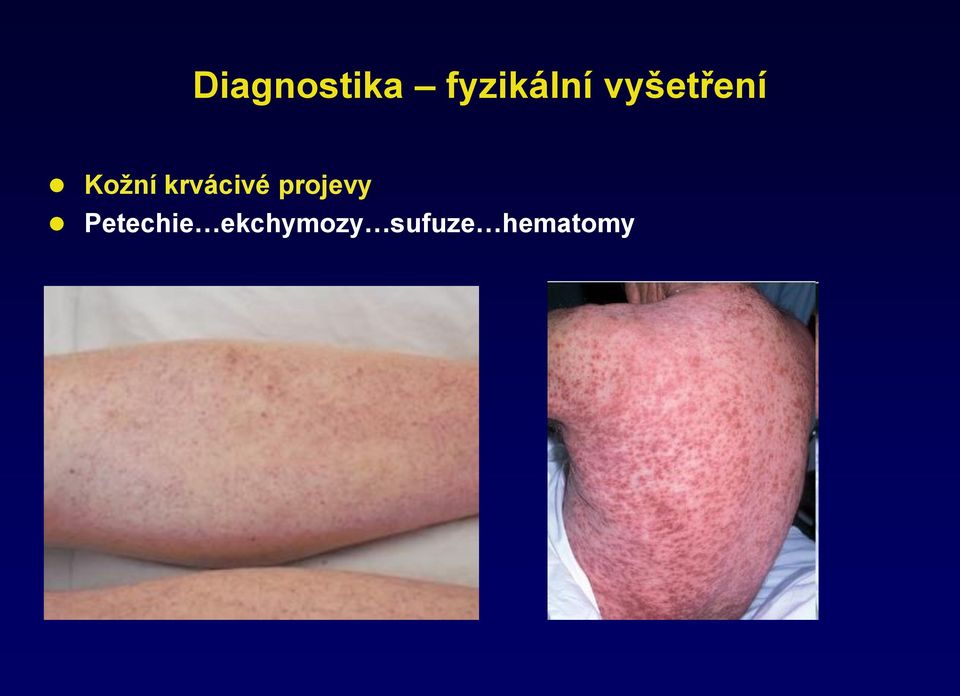 krvácivé projevy