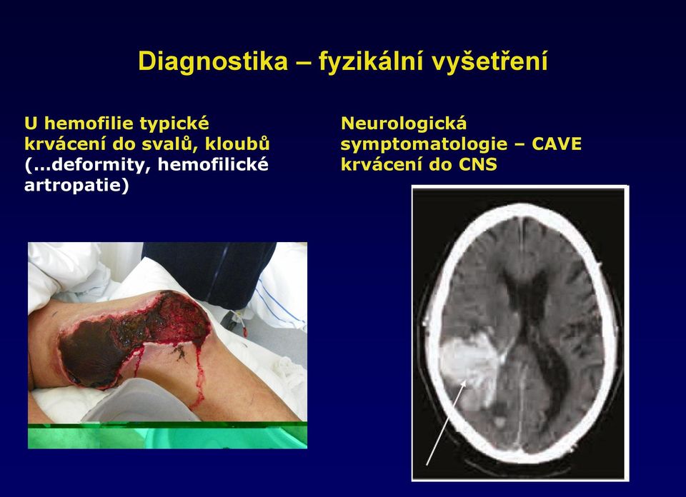 kloubů ( deformity, hemofilické