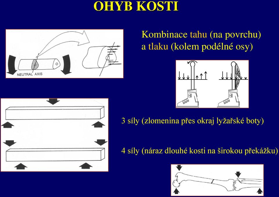 (zlomenina přes okraj lyžařské boty) 4