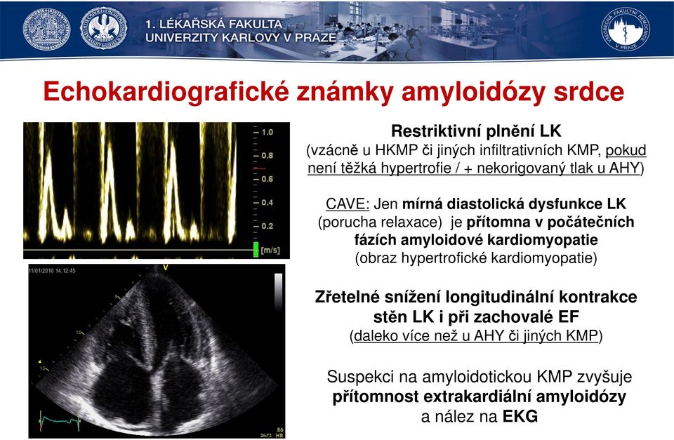 fázích amyloidové kardiomyopatie (obraz hypertrofické kardiomyopatie) Zřetelné snížení longitudinální kontrakce stěn LK i při