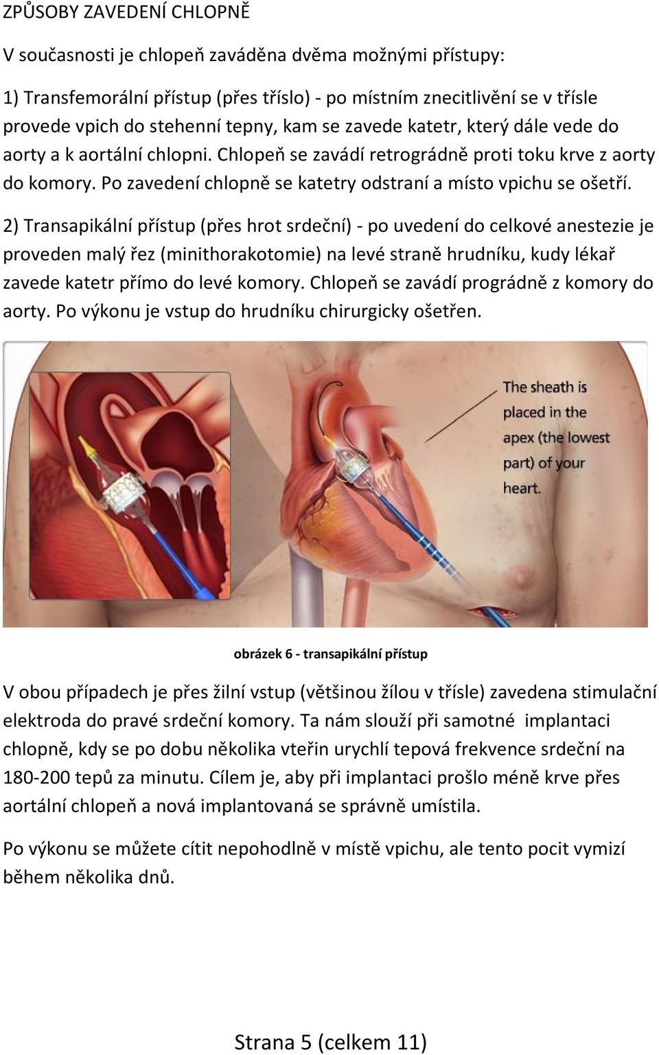 2) Transapikální přístup (přes hrot srdeční) - po uvedení do celkové anestezie je proveden malý řez (minithorakotomie) na levé straně hrudníku, kudy lékař zavede katetr přímo do levé komory.