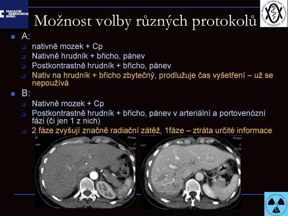 vyšetření už se nepoužívá Nativně mozek + Cp Postkontrastně hrudník + břicho, pánev v