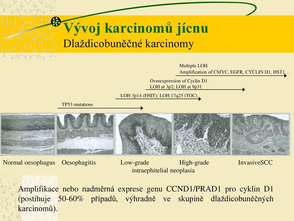 oesophagus Oesophagitis Low-grade High-grade InvasiveSCC intraephitelial neoplasia Amplifikace nebo nadměrná