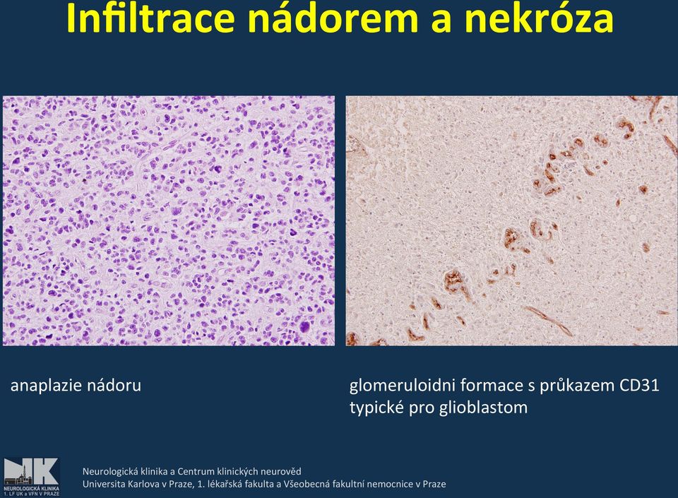 glomeruloidni formace s