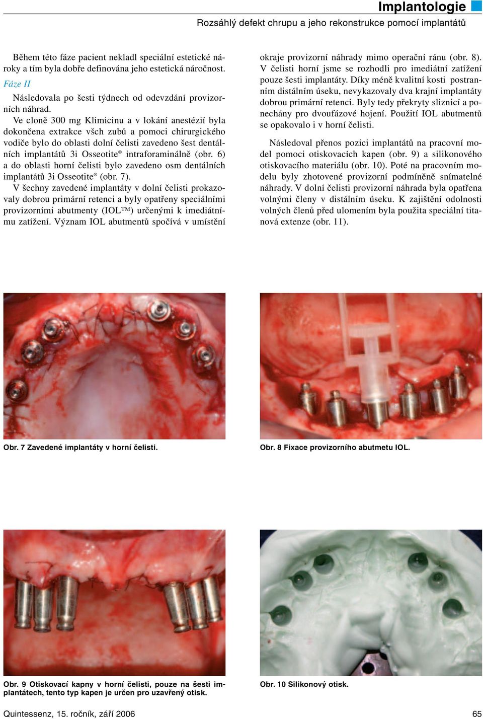 intraforaminálně (obr. 6) a do oblasti horní čelisti bylo zavedeno osm dentálních implantátů 3i Osseotite (obr. 7).