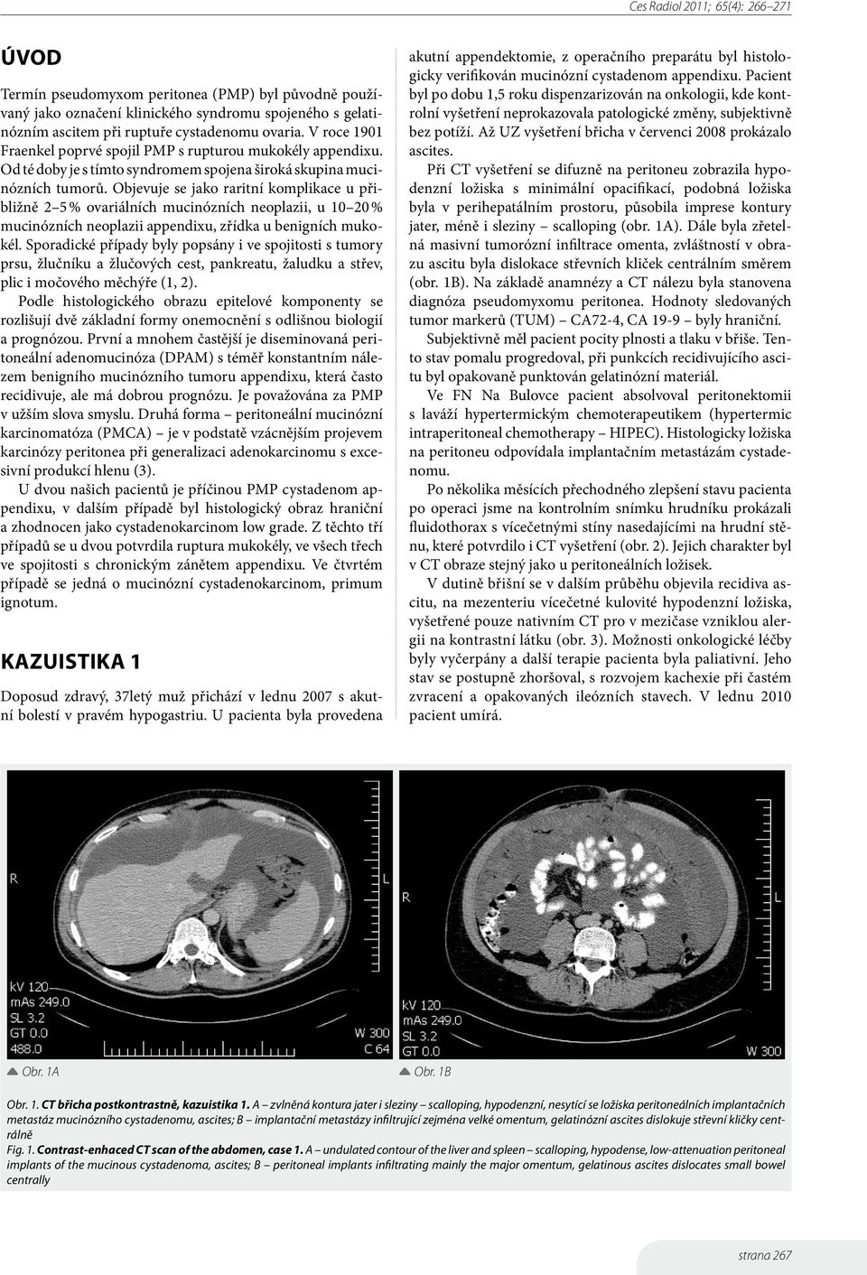 Objevuje se jako raritní komplikace u přibližně 2 5 % ovariálních mucinózních neoplazii, u 10 20 % mucinózních neoplazii appendixu, zřídka u benigních mukokél.