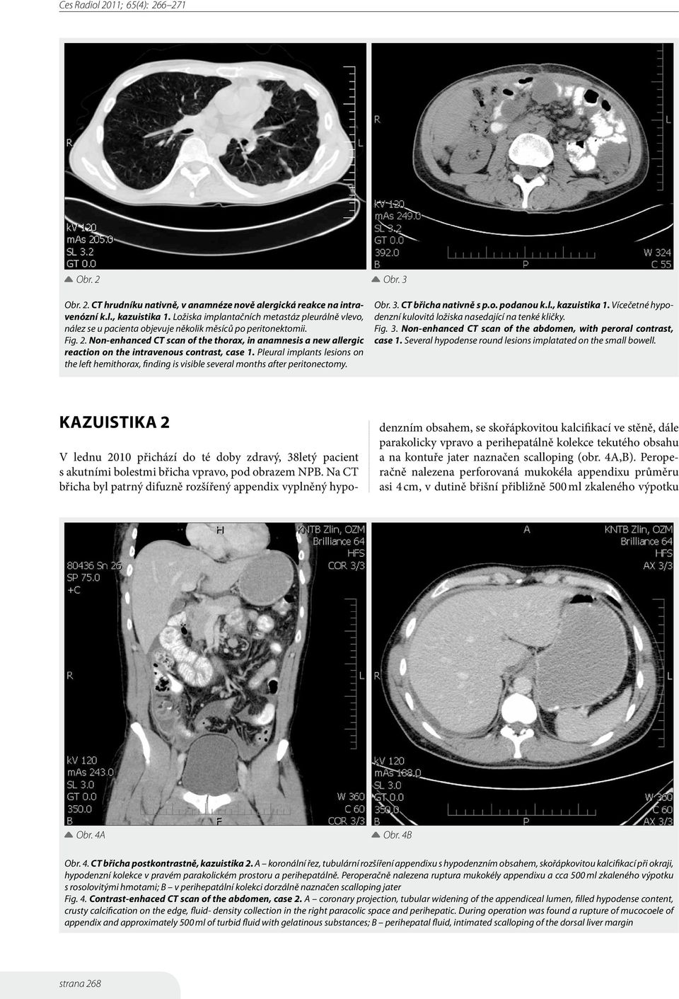 Non-enhanced CT scan of the thorax, in anamnesis a new allergic reaction on the intravenous contrast, case 1.