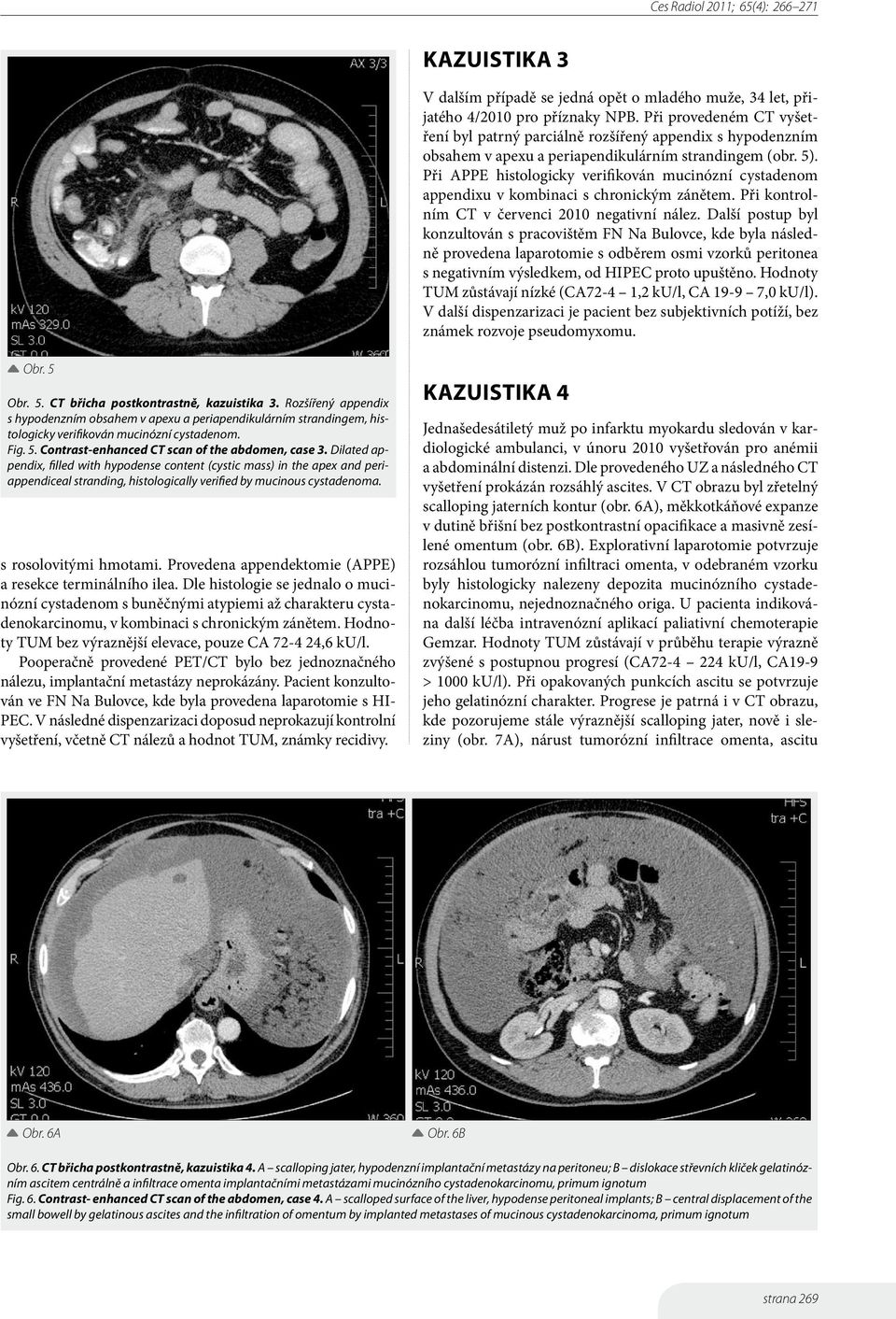 Při APPE histologicky verifikován mucinózní cystadenom appendixu v kombinaci s chronickým zánětem. Při kontrolním CT v červenci 2010 negativní nález.