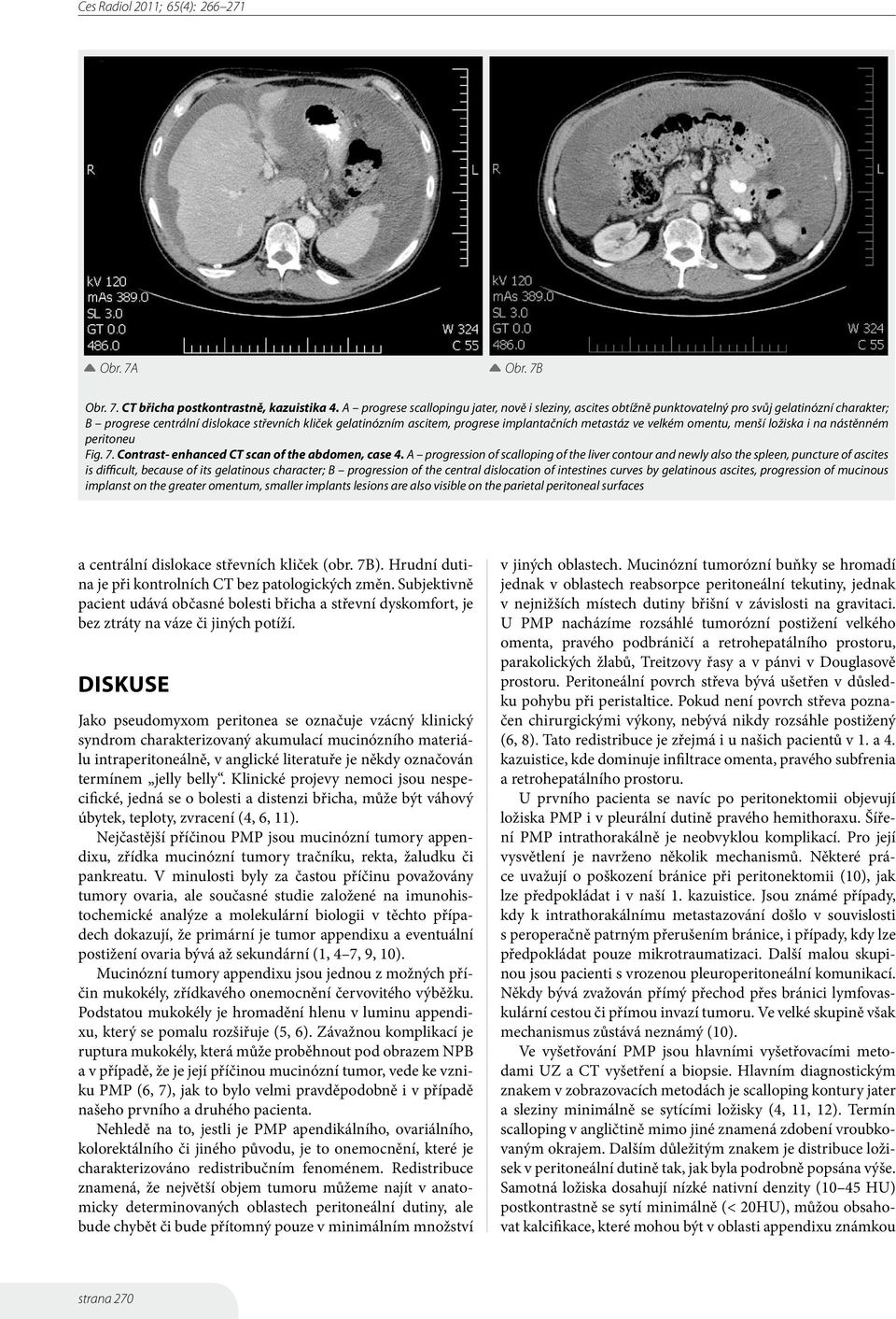 implantačních metastáz ve velkém omentu, menší ložiska i na nástěnném peritoneu Fig. 7. Contrast- enhanced CT scan of the abdomen, case 4.