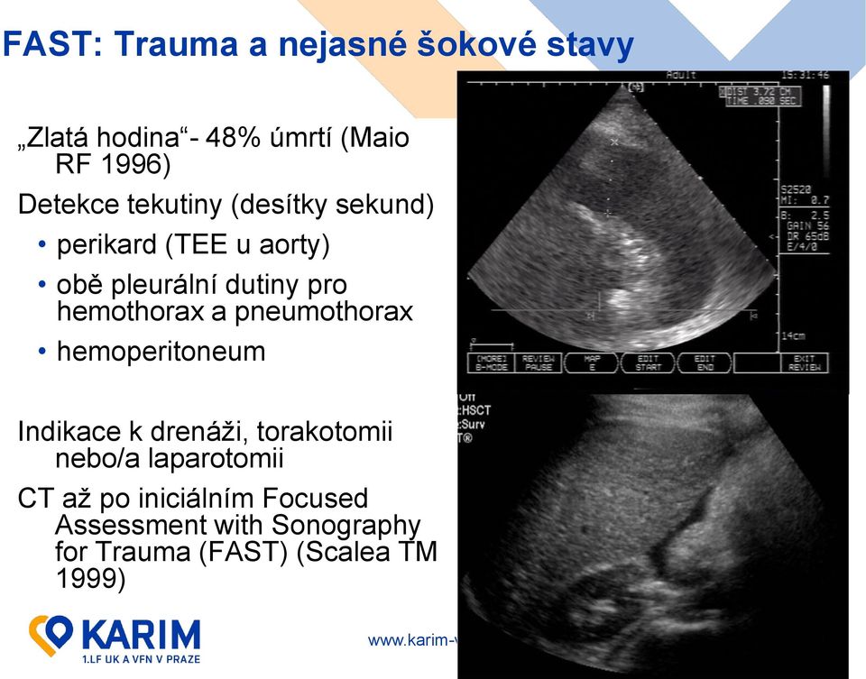 a pneumothorax hemoperitoneum Indikace k drenáži, torakotomii nebo/a laparotomii CT