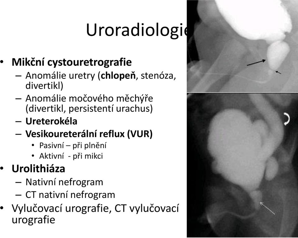 Ureterokéla Vesikoureterální reflux (VUR) Pasivní při plnění Aktivní - při mikci