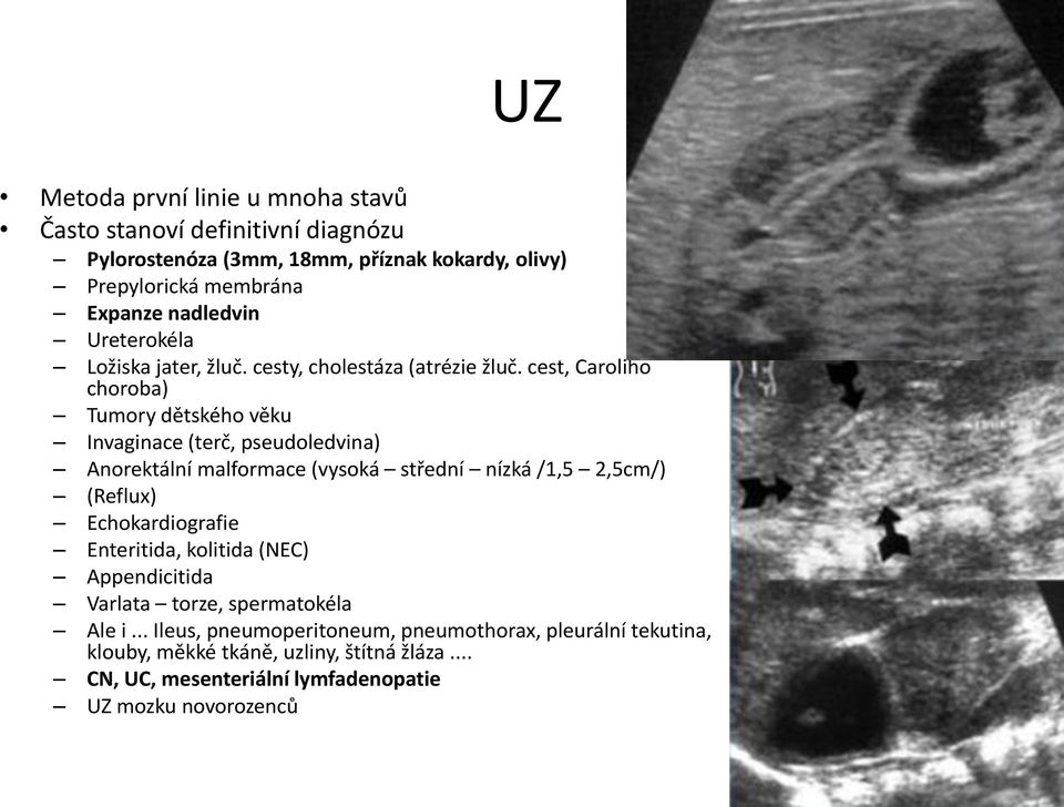 cest, Caroliho choroba) Tumory dětského věku Invaginace (terč, pseudoledvina) Anorektální malformace (vysoká střední nízká /1,5 2,5cm/) (Reflux)