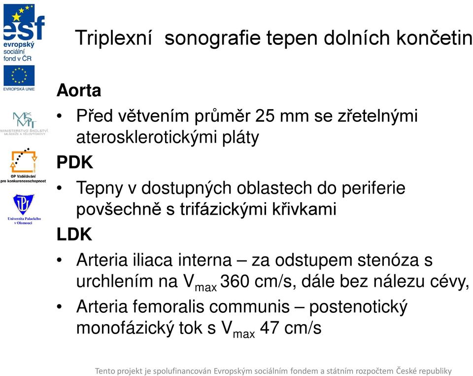 trifázickými křivkami LDK Arteria iliaca interna za odstupem stenóza s urchlením na V max