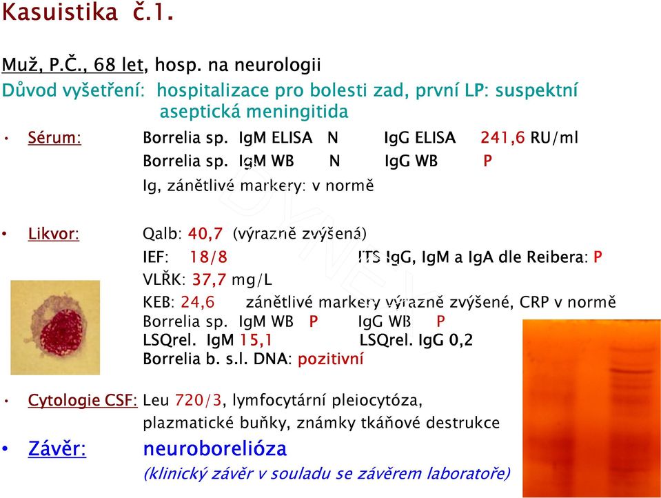 IgM WB N IgG WB P Ig, zánětlivé markery: v normě Likvor: Qalb: 40,7 (výrazně zvýšená) IEF: 18/8 ITS IgG, IgM a IgA dle Reibera: P VLŘK: 37,7 mg/l KEB: 24,6 zánětlivé