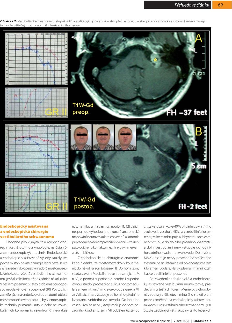 schwannomu Obdobně jako v jiných chirurgických oborech, včetně otorinolaryngologie, narůstá význam endoskopických technik.