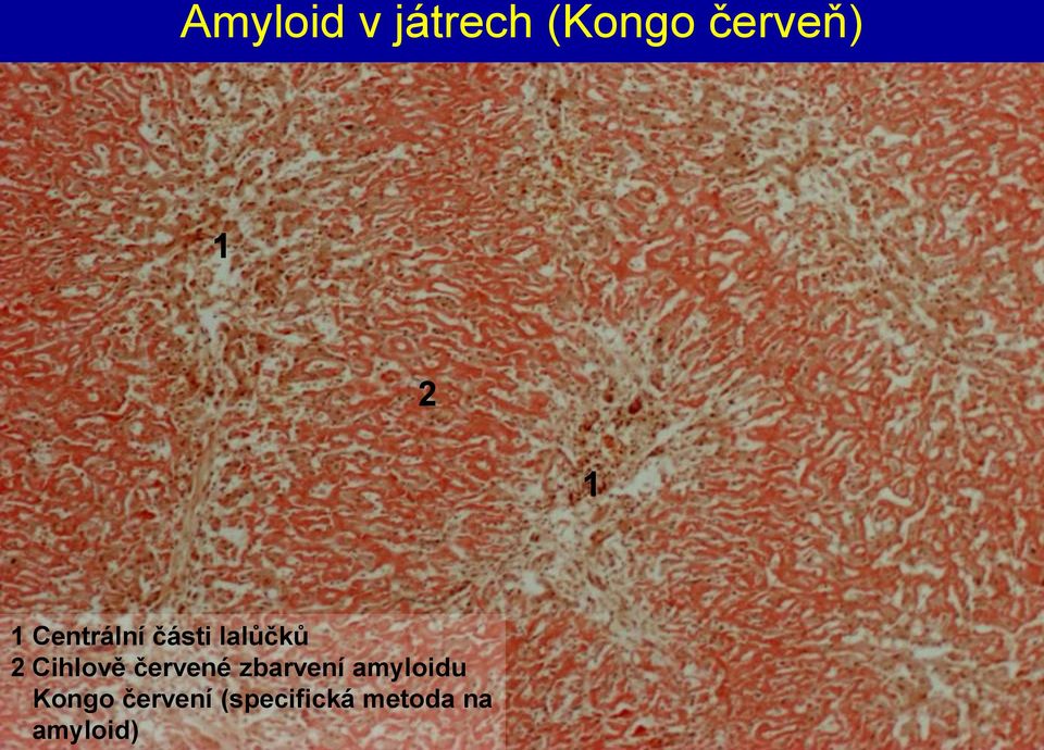 Cihlově červené zbarvení amyloidu