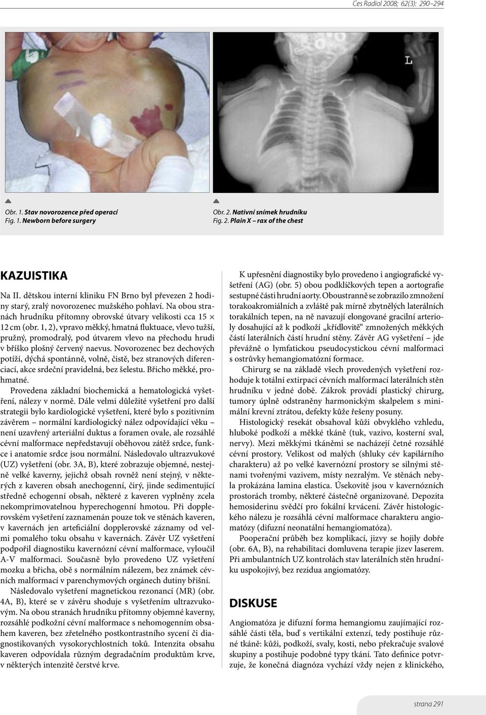 1, 2), vpravo měkký, hmatná fluktuace, vlevo tužší, pružný, promodralý, pod útvarem vlevo na přechodu hrudi v bříško plošný červený naevus.