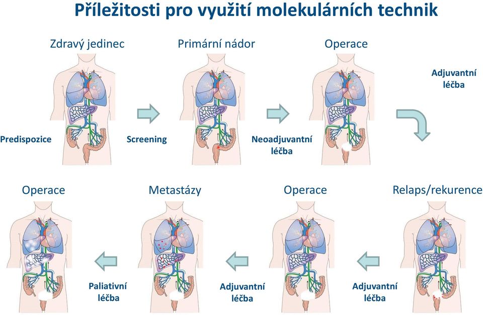 léčba Predispozice Screening Neoadjuvantní léčba Operace Metastázy