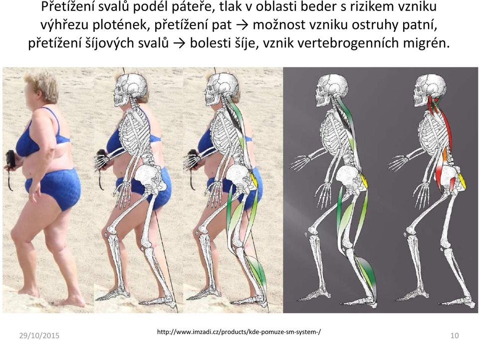 patní, přetížení šíjových svalů bolesti šíje, vznik