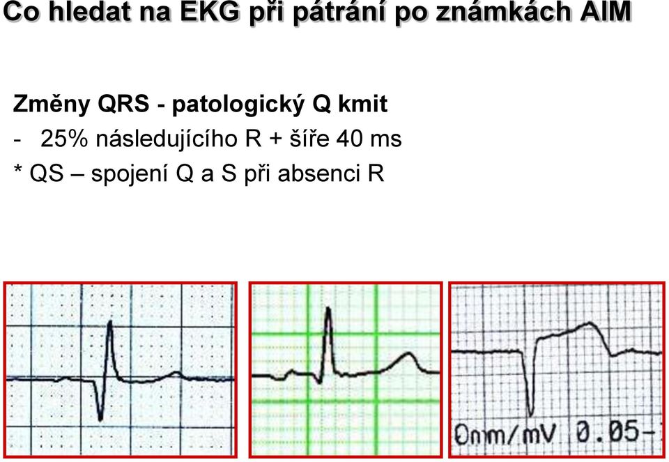 patologický Q kmit - 25%