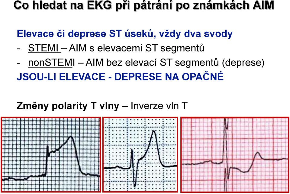 segmentů - nonstemi AIM bez elevací ST segmentů (deprese)