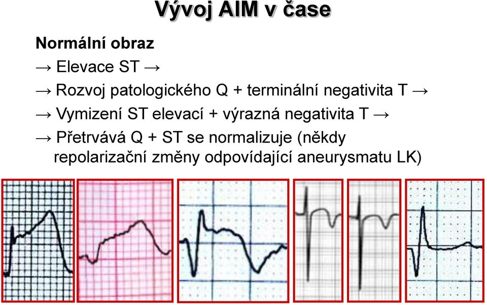 elevací + výrazná negativita T Přetrvává Q + ST se