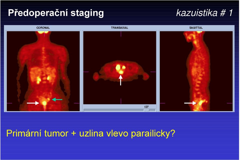 # 1 Primární tumor