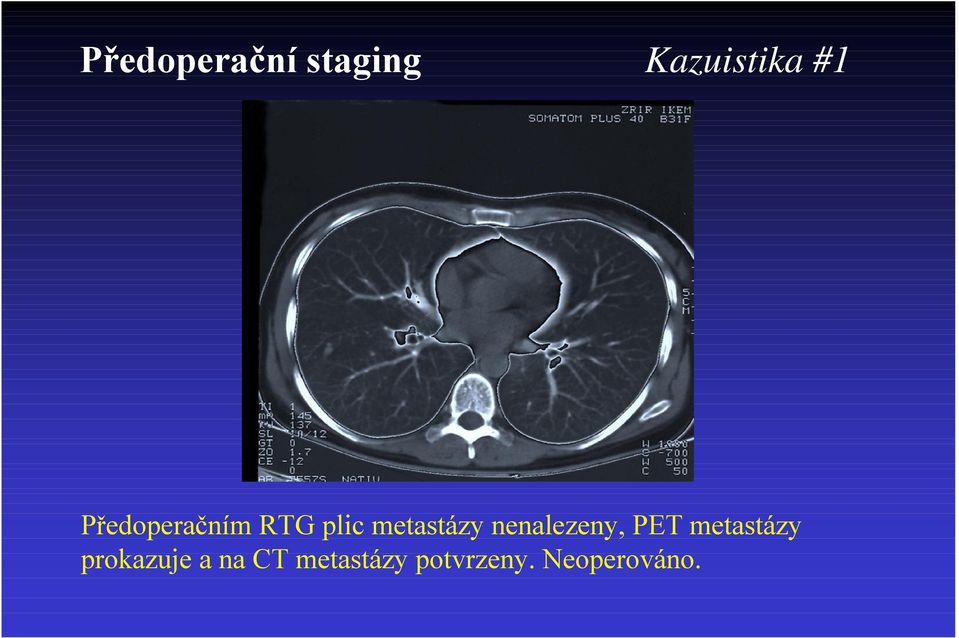 nenalezeny, PET metastázy prokazuje