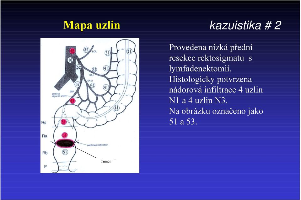 Histologicky potvrzena nádorová infiltrace 4