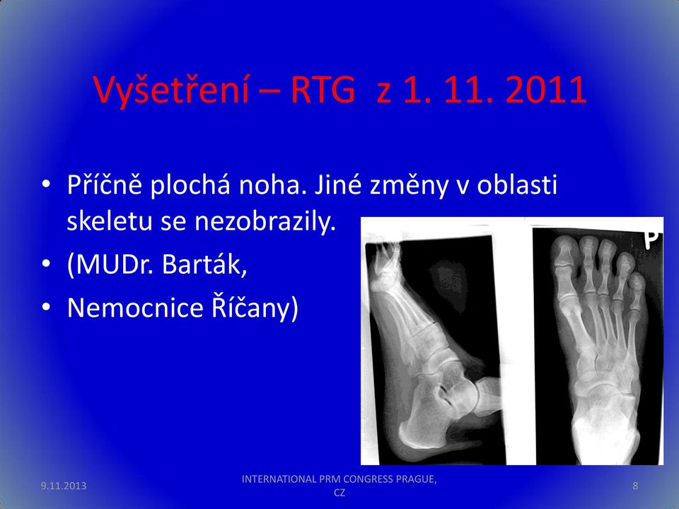 Jiné změny v oblasti skeletu se