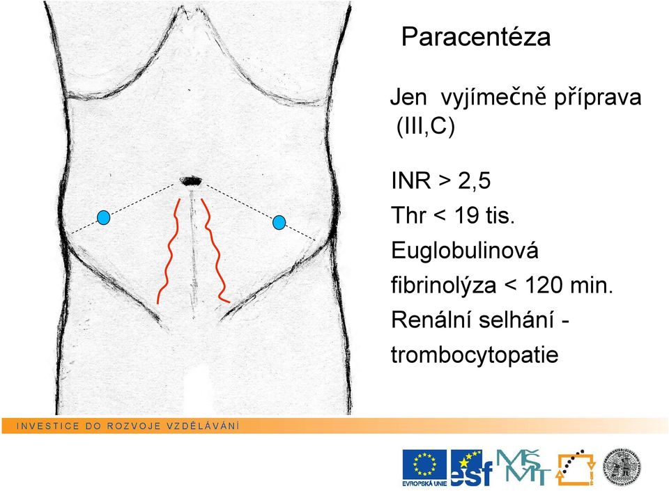 Euglobulinová fibrinolýza < 120