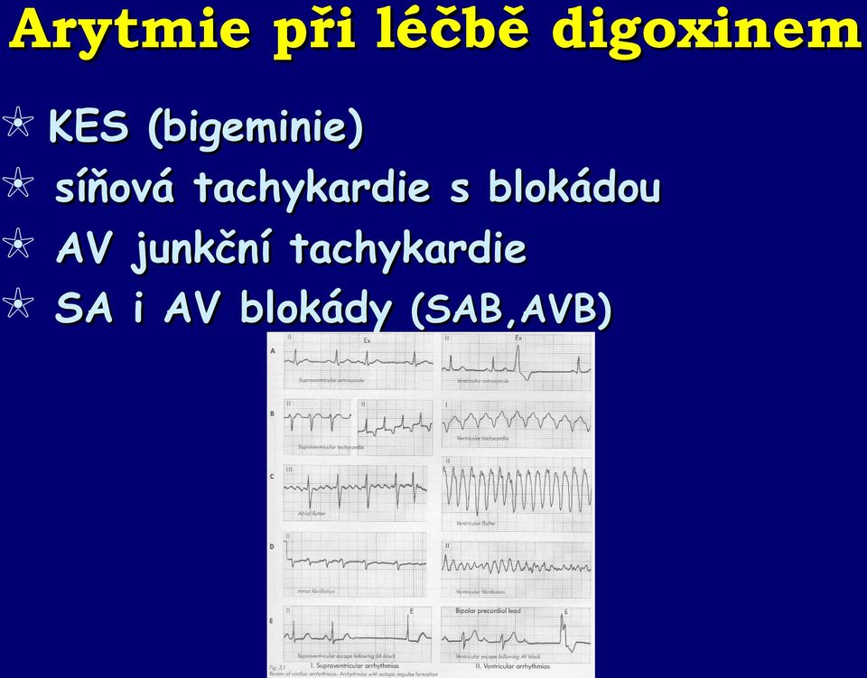 tachykardie s blokádou AV