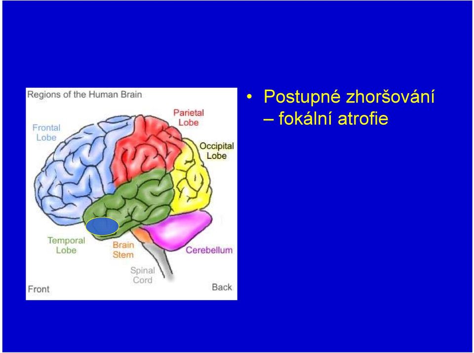 fokální atrofie  