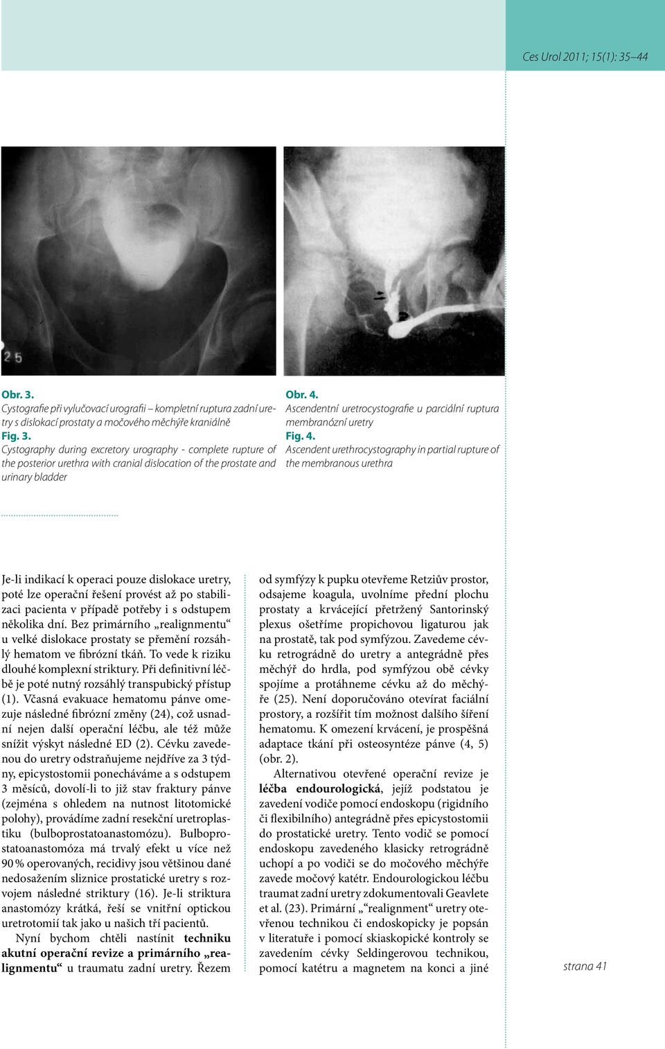 Ascendent urethrocystography in partial rupture of the membranous urethra Je-li indikací k operaci pouze dislokace uretry, poté lze operační řešení provést až po stabilizaci pacienta v případě