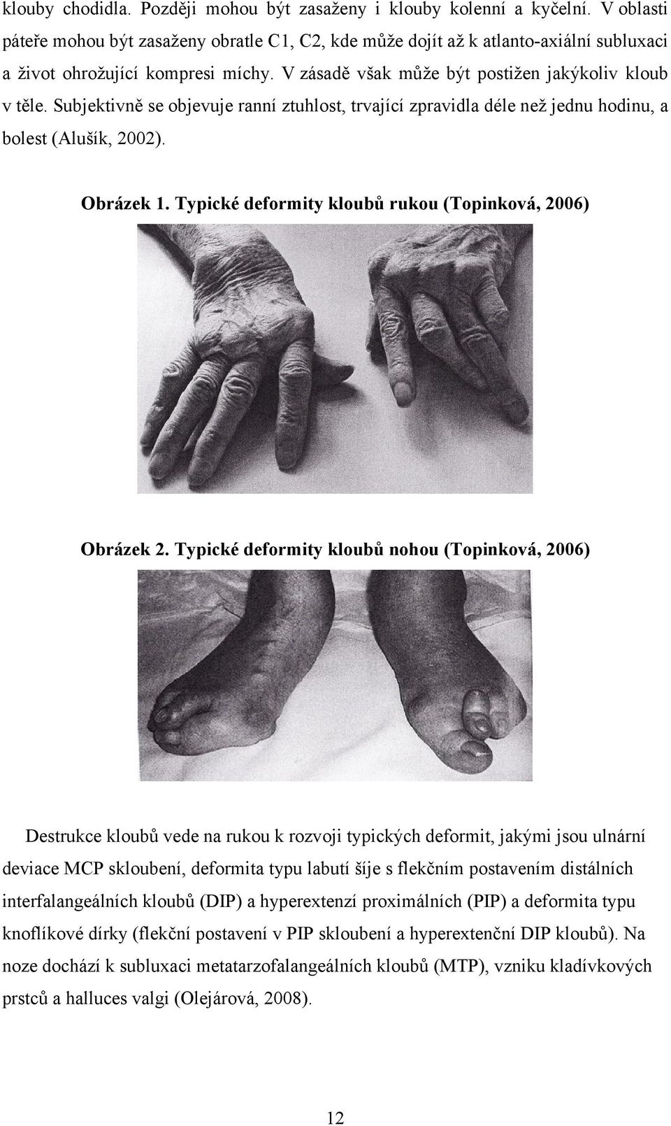 Subjektivně se objevuje ranní ztuhlost, trvající zpravidla déle než jednu hodinu, a bolest (Alušík, 2002). Obrázek 1. Typické deformity kloubů rukou (Topinková, 2006) Obrázek 2.