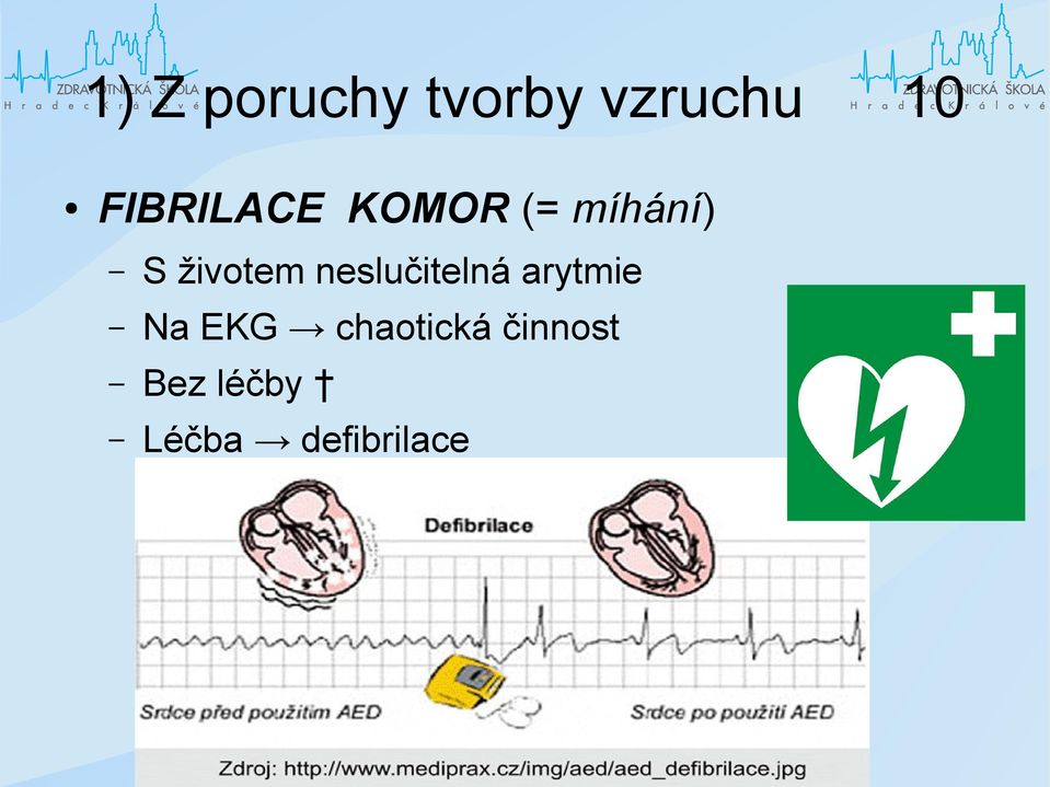 životem neslučitelná arytmie Na EKG