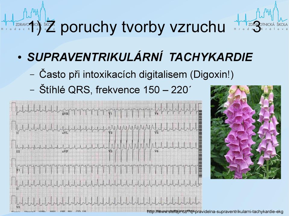 (Digoxin!) Štíhlé QRS, frekvence 150 220 http://www.